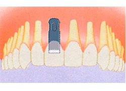  インプラント