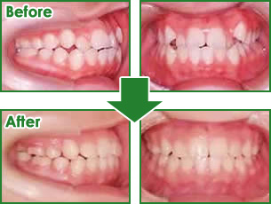 矯正歯科治療
