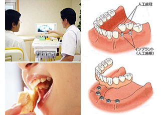 インプラント治療