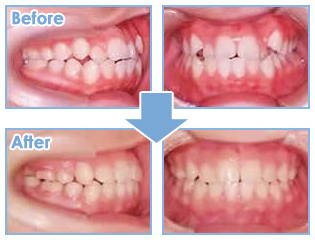 矯正歯科治療