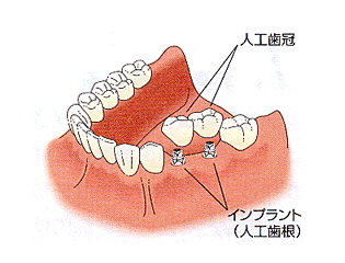 インプラント