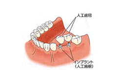 インプラント治療